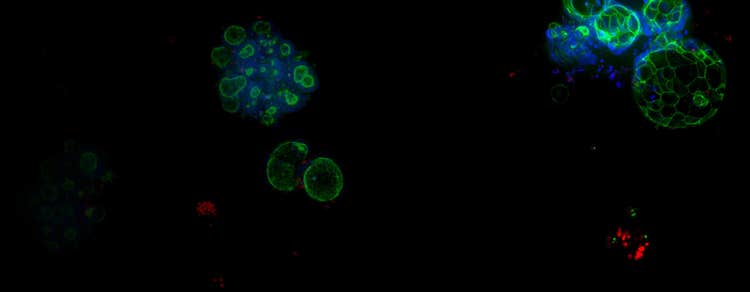 colorectal cancer organoid