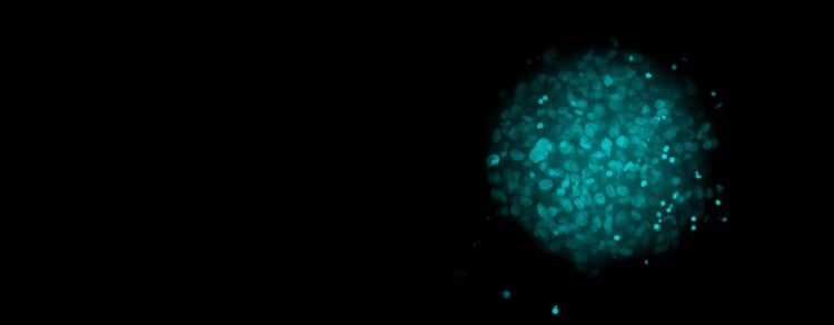 3D cancer spheroid assays