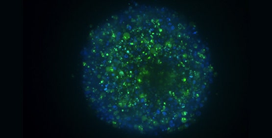 3D Cancer spheroids mimic tumor