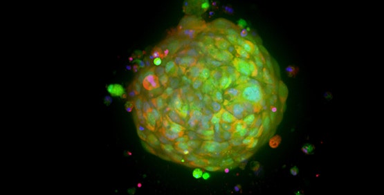 Patient-Derived Organoids (Tumoroids)