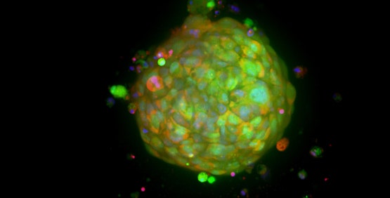 Patient-derived organoids (Tumoroids)