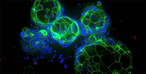 Colorectal Cancer Organoids