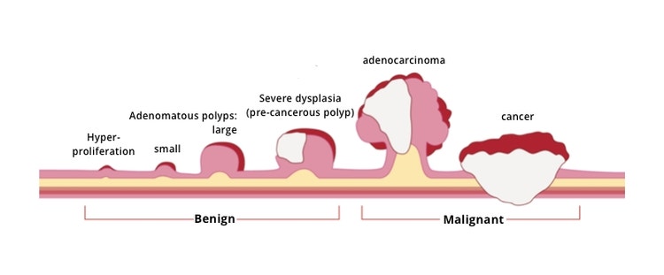 Colorectal cancer progression (image from Guts UK Charity)