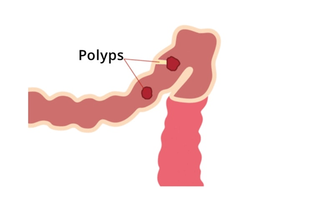 FAP and MAP are inherited conditions that can lead to the formation of hundreds to thousands of colorectal polyps (image from Guts UK Charity)